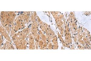 Immunohistochemistry of paraffin-embedded Human esophagus cancer tissue using SLC4A3 Polyclonal Antibody at dilution of 1:35(x200) (SLC4A3 Antikörper)