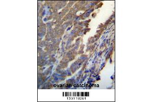 ASB4 Antibody immunohistochemistry analysis in formalin fixed and paraffin embedded human ovarian carcinoma followed by peroxidase conjugation of the secondary antibody and DAB staining. (ASB4 Antikörper  (C-Term))