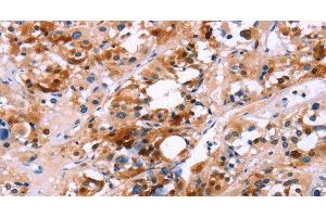 Immunohistochemistry of paraffin-embedded Human thyroid cancer using CALB1 Polyclonal Antibody at dilution of 1:60 (CALB1 Antikörper)