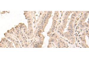 Immunohistochemistry of paraffin-embedded Human thyroid cancer tissue using SAP130 Polyclonal Antibody at dilution of 1:50(x200) (SAP130 Antikörper)
