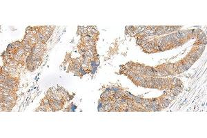 Immunohistochemistry of paraffin-embedded Human colorectal cancer tissue using SLC6A9 Polyclonal Antibody at dilution of 1:25(x200) (GLYT1 Antikörper)
