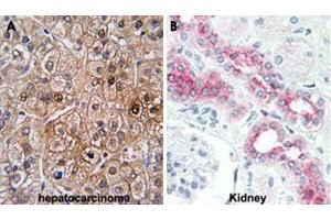 Formalin-fixed and paraffin-embedded human hepatocarcinoma (A) and human kidney (B) tissue reacted with BMPR2 polyclonal antibody , which was peroxidase-conjugated to the secondary antibody, followed by DAB staining. (BMPR2 Antikörper  (AA 28-59))