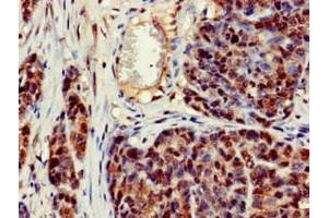 Immunohistochemistry of paraffin-embedded human ovarian cancer using ABIN7150470 at dilution of 1:100 (CRCP Antikörper  (AA 1-115))