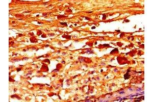 Immunohistochemistry of paraffin-embedded human melanoma using ABIN7152751 at dilution of 1:100 (Fibrillin 1 Antikörper  (AA 783-850))