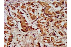 IHC image of ABIN7157898 diluted at 1:200 and staining in paraffin-embedded human liver cancer performed on a Leica BondTM system. (LAMC2 Antikörper  (AA 417-588))