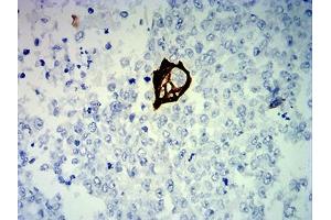 Immunohistochemical analysis of paraffin-embedded breast cancer tissues using KRT13 mouse mAb with DAB staining. (Cytokeratin 13 Antikörper  (AA 104-458))