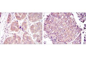 Immunohistochemical analysis of paraffin-embedded liver cancer tissues (left) and lung cancer tissues (right) using HIF1A mouse mAb with DAB staining. (HIF1A Antikörper)