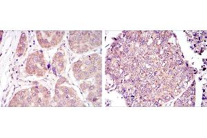Immunohistochemical analysis of paraffin-embedded liver cancer tissues (left) and lung cancer tissues (right) using HIF1A mouse mAb with DAB staining.