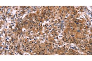 Immunohistochemistry of paraffin-embedded Human gastric cancer tissue using HACE1 Polyclonal Antibody at dilution 1:40 (HACE1 Antikörper)