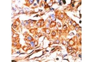 IHC analysis of FFPE human breast carcinoma stained with the Glycerol kinase antibody (GK2 Antikörper  (AA 487-515))