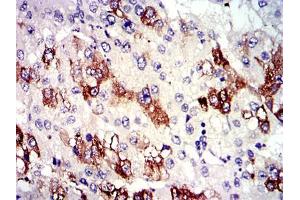 Immunohistochemical analysis of paraffin-embedded liver cancer tissues using TUBA8 mouse mAb with DAB staining.