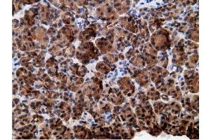 Immunohistochemical staining of paraffin-embedded Adenocarcinoma of Human colon tissue using anti-EPHX2 mouse monoclonal antibody. (EPHX2 Antikörper)