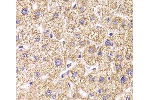 Immunohistochemistry of paraffin-embedded Human liver damage using ST3GAL3 Polyclonal Antibody at dilution of 1:100 (40x lens). (ST3GAL3 Antikörper)