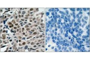 Immunohistochemistry analysis of paraffin-embedded human breast carcinoma, using FKHRL1 (Phospho-Ser253) Antibody. (FOXO3 Antikörper  (pSer253))