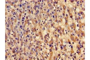 Immunohistochemistry of paraffin-embedded human liver cancer using ABIN7154002 at dilution of 1:100 (GCLM Antikörper  (Regulatory Subunit))