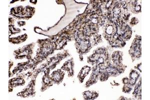 IHC testing of FFPE human renal cancer tissue with Purine nucleoside phosphorylase antibody at 1ug/ml. (PNP Antikörper  (AA 161-189))