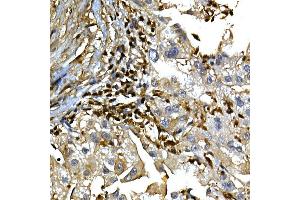 Immunohistochemistry of paraffin-embedded human liver cancer using [KO Validated]  Rabbit pAb (ABIN6133581 and ABIN6136917) at dilution of 1:100 (40x lens). (Annexin a1 Antikörper)