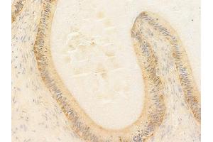 ABIN7097091 and ABIN7101158 at 1/100 staining human testicular cancer by IHC-P. (NCF1C Antikörper)