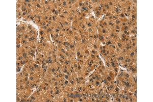 Immunohistochemistry of Human liver cancer using CCNT1 Polyclonal Antibody at dilution of 1:30 (Cyclin T1 Antikörper)