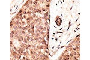 IHC analysis of FFPE human breast carcinoma tissue stained with the CDX2 antibody (CDX2 Antikörper  (AA 1-30))