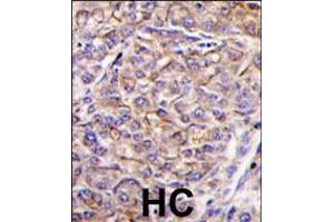 Formalin-fixed and paraffin-embedded human hepatocarcinoma tissue reacted with TAOK3 antibody , which was peroxidase-conjugated to the secondary antibody, followed by DAB staining. (TAO Kinase 3 Antikörper  (C-Term))