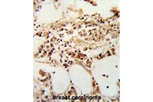 Formalin-fixed and paraffin-embedded human breast carcinoma reacted with TIMP3 Antibody (Center), which was peroxidase-conjugated to the secondary antibody, followed by DAB staining. (TIMP3 Antikörper  (Middle Region))