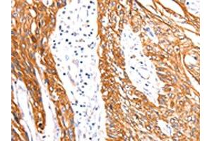 The image on the left is immunohistochemistry of paraffin-embedded Human esophagus cancer tissue using ABIN7192115(Rab3D Antibody) at dilution 1/27, on the right is treated with synthetic peptide. (RAB3D Antikörper)