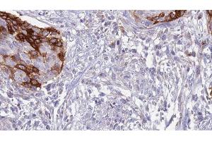 ABIN6273638 at 1/100 staining Human urothelial cancer tissue by IHC-P. (IL12RB1 Antikörper  (Internal Region))