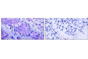 Immunohistochemical analysis of paraffin- embedded human breast carcinoma tissue using PDK1 (phospho-Ser241) antibody (E011005). (PDPK1 Antikörper  (pSer241))