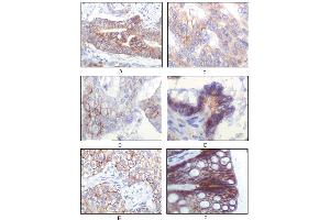 Immunohistochemical analysis of paraffin-embedded human gastric adenocarcinoma(A), golon adenocarcinoma (B), endometrial carcinoma (uterus) (C), ovary adenocarcinoma (D), lung squamous cell carcinoma (E), stomach epithelium mucosae (F), showing membrane localization using IGF1R mouse mAb with DAB staining. (IGF1R Antikörper)