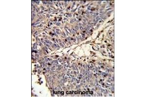 Formalin-fixed and paraffin-embedded human lung carcinoma reacted with CFL1 Antibody (N-term), which was peroxidase-conjugated to the secondary antibody, followed by DAB staining. (Cofilin Antikörper  (N-Term))