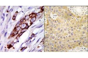 (LEFT)Formalin-fixed and paraffin-embedded human cancer tissue reacted with the primary antibody, which was peroxidase-conjugated to the secondary antibody, followed by DAB staining. (GRK5 Antikörper  (C-Term))