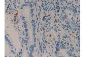 IHC-P analysis of Human Stomach cancer Tissue, with DAB staining. (LAMC2 Antikörper  (AA 416-602))
