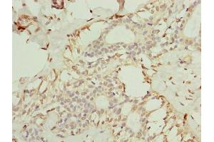 Immunohistochemistry of paraffin-embedded human breast cancer using ABIN7173079 at dilution of 1:100 (TMEM154 Antikörper  (AA 97-183))