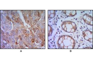 Immunohistochemical analysis of paraffin-embedded human lung cancer (A), colon cancer (B) using ST13 mouse mAb with DAB staining.