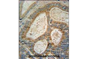 INSIG1 Antibody immunohistochemistry analysis in formalin fixed and paraffin embedded human prostate carcinoma followed by peroxidase conjugation of the secondary antibody and DAB staining. (INSIG1 Antikörper  (N-Term))