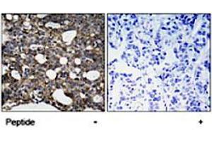 Immunohistochemical analysis of paraffin-embedded human breast carcinoma tissue using GJA1 (phospho S367) polyclonal antibody . (Connexin 43/GJA1 Antikörper  (pSer367))