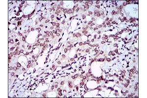 Immunohistochemistry (IHC) image for anti-Zinc Finger E-Box Binding Homeobox 1 (ZEB1) (AA 967-1108) antibody (ABIN1724885)
