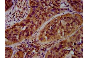 IHC image of ABIN7167931 diluted at 1:600 and staining in paraffin-embedded human cervical cancer performed on a Leica BondTM system. (ARHGAP15 Antikörper  (AA 1-154))