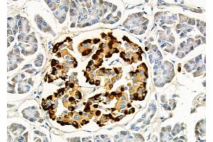 ABIN6257133 and ABIN6275805 at 1/100 staining Human pancreatic cancer and adjacent nomal tissues by IHC-P. (Topoisomerase I Antikörper  (Internal Region))