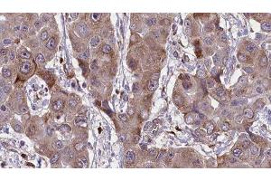 ABIN6276659 at 1/100 staining Human liver cancer tissue by IHC-P. (CD44 Antikörper  (Internal Region))
