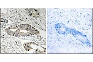 Immunohistochemistry analysis of paraffin-embedded human colon carcinoma tissue, using EPN3 Antibody. (EPN3 Antikörper  (AA 401-450))