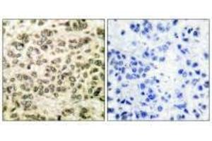 Immunohistochemical analysis of paraffin-embedded human breast carcinoma tissue using HDAC3 antibody.