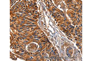Immunohistochemistry of Human lung cancer using LGALS8 Polyclonal Antibody at dilution of 1:50 (LGALS8 Antikörper)