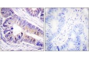 Immunohistochemistry analysis of paraffin-embedded human colon carcinoma tissue, using 14-3-3 zeta/delta (Ab-232) Antibody. (14-3-3 zeta Antikörper  (AA 196-245))