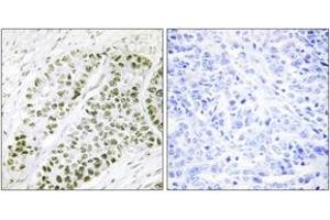 Immunohistochemistry analysis of paraffin-embedded human lung carcinoma, using ATF2 (Phospho-Ser480) Antibody. (ATF2 Antikörper  (pSer480))