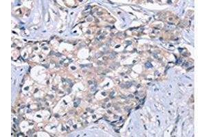 The image on the left is immunohistochemistry of paraffin-embedded Human breast cancer tissue using ABIN7129969(KCNQ5 Antibody) at dilution 1/60, on the right is treated with fusion protein.