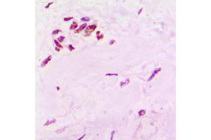 Immunohistochemical analysis of SOX6 staining in human lung cancer formalin fixed paraffin embedded tissue section.