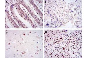 Immunohistochemical analysis of paraffin-embedded human rectum cancer tissue (A), placenta tissue (B), brain tissue (C) and esophageal cancer tissue (D) using CDK9 monoclonal antibody, clone 1B5A7  with DAB staining.
