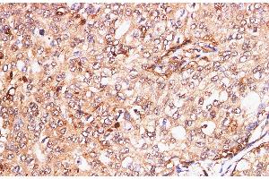 Immunohistochemistry of paraffin-embedded Human breast cancer using S100A11 Polyclonal Antibody at dilution of 1:200 (S100A11 Antikörper)